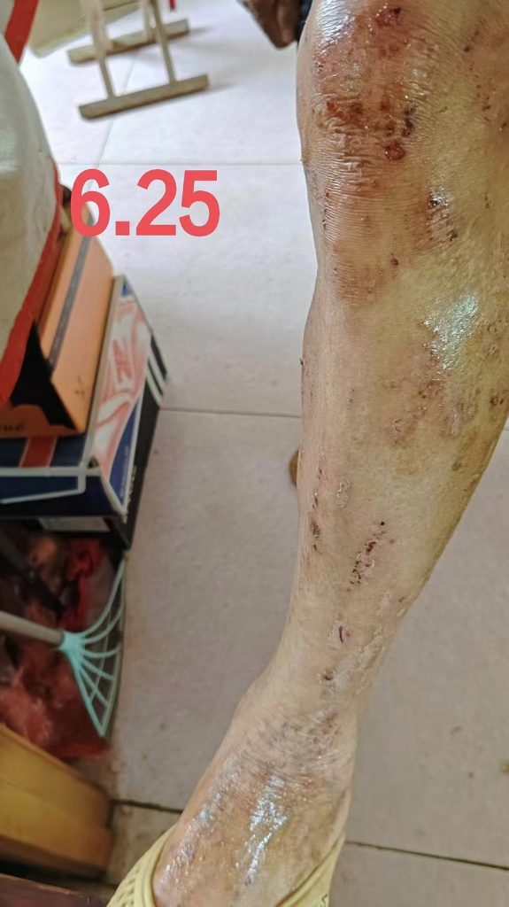 顽固性湿疹（慎重点开）-减脂塑形优享社区-健康管理-优享健康生活社区